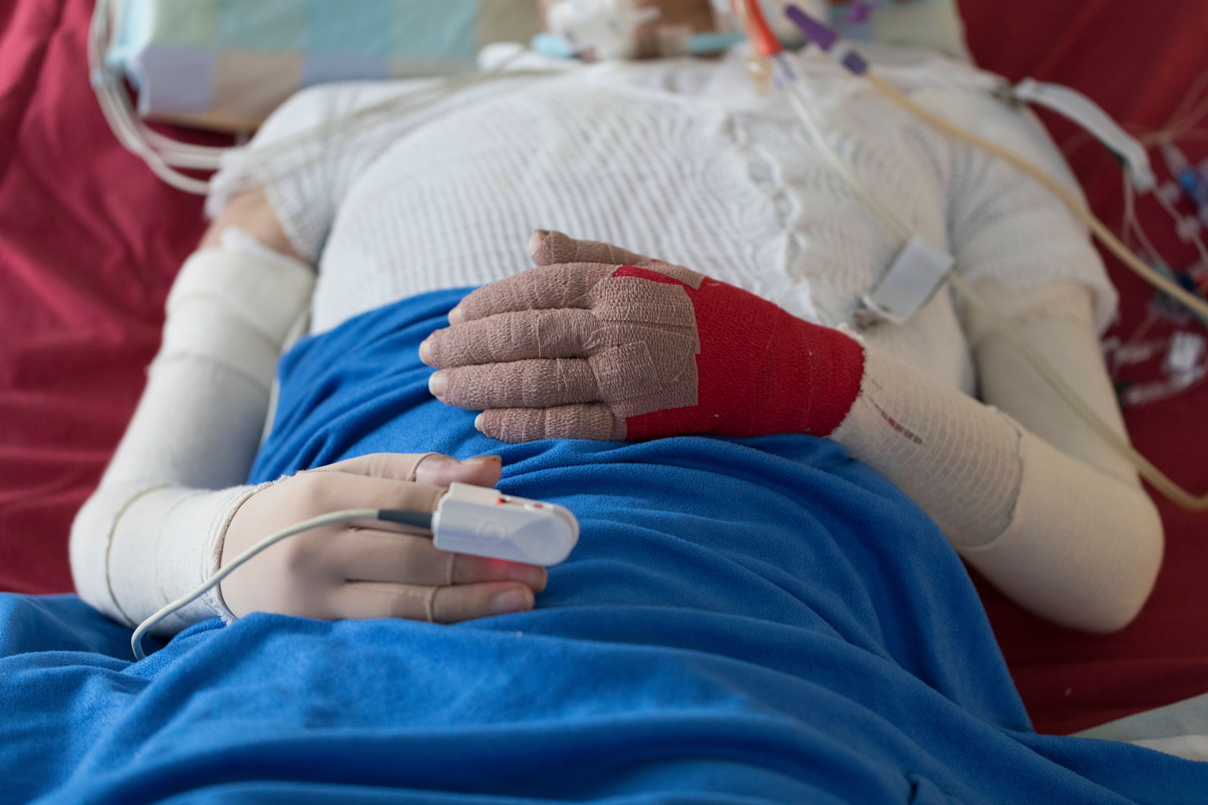 Nach-Crans-Montana-Wie-moderne-Medizin-selbst-schwerste-Brandopfer-berleben-l-sst